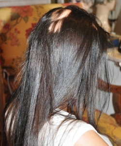 tratamiento de alopecias en jovenes tratamiento de alopecias en jovenes