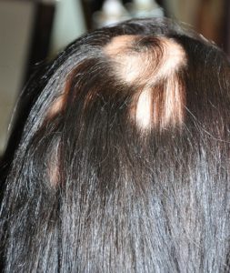 Tapando alopecia en una joven