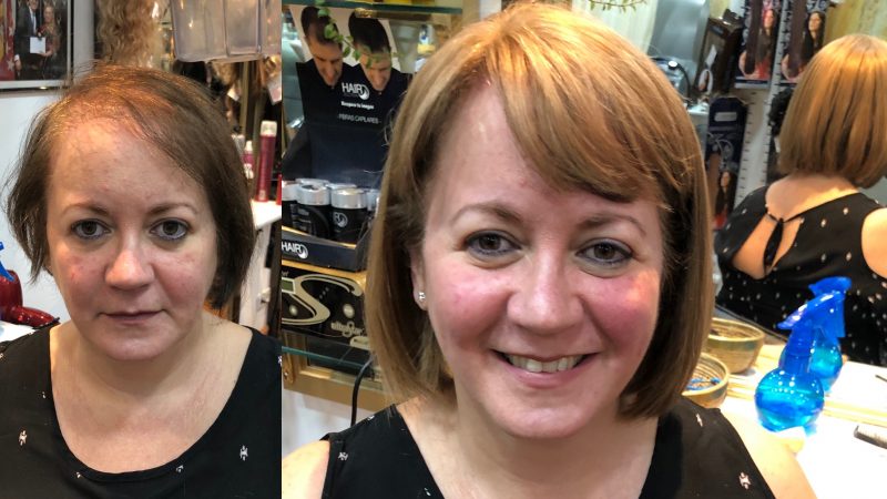 antes y despues de los servicios para cubrir alopecias en soledad cabello pelucas y extensiones madrid