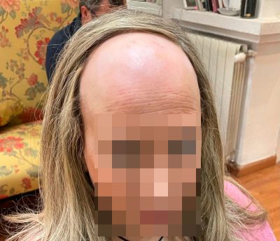 Clienta-con-cabello-rubio-antes-de-la-colocacion-de-las-protesis-capilares-para-la-alopecia-fronta-fibrosante-en-Madrid-recortada Clienta con cabello rubio antes de la colocacion de las protesis capilares para la alopecia fronta fibrosante en Madrid