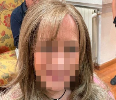 Clienta-con-cabello-rubio-despues-de-la-colocacion-de-las-protesis-capilares-para-la-alopecia-fronta-fibrosante-en-Madrid-recortada Clienta con cabello rubio despues de la colocacion de las protesis capilares para la alopecia fronta fibrosante en Madrid