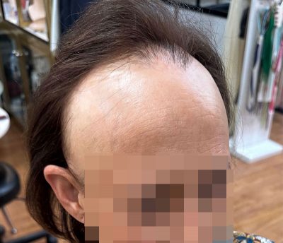 clienta-con-alopecia-frontal-fibrosante-antes-de-la-colocacion-de-protesis-capilares-recortada clienta con alopecia frontal fibrosante antes de la colocacion de protesis capilares